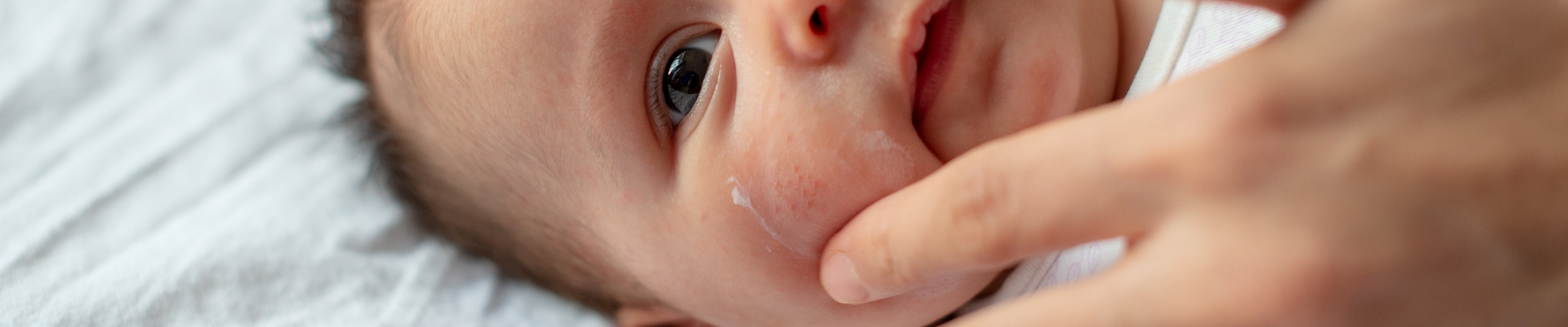 Common Newborn Rashes Parent Survival Guide Parentmd Common Newborn Rashes Parent Survival Guide Parentmd